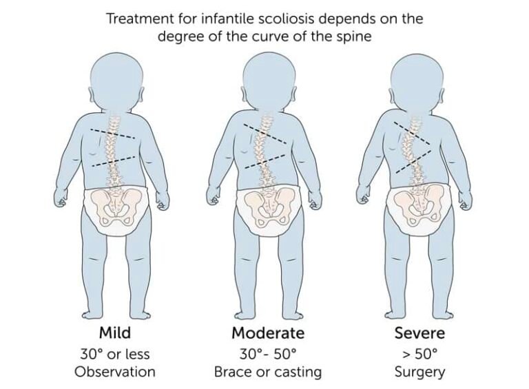 Scoliosis: When a Back Curve Goes Too Far – The Holistic Health Centre
