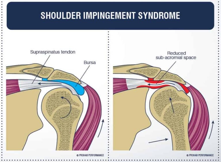 What You Need to Know About That Pinch in Your Shoulder – The Holistic ...