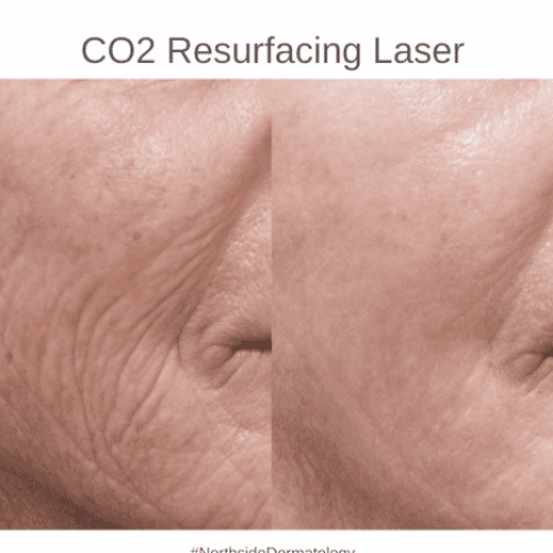 CO2 Laser - 5