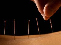 acupuncture 1