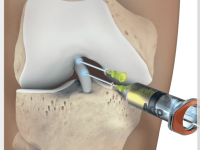 home page - Treatments 'Orthopaedic PRP Injections'